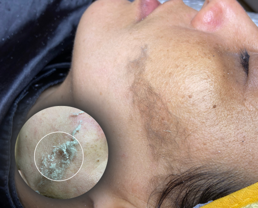 Dermaplaning